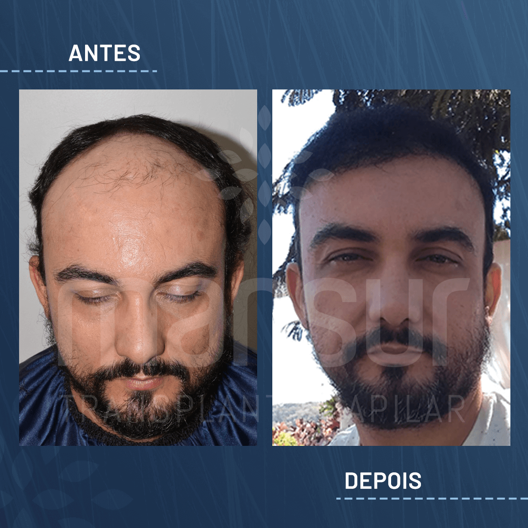 Antes e Depois_site_Wanderlan