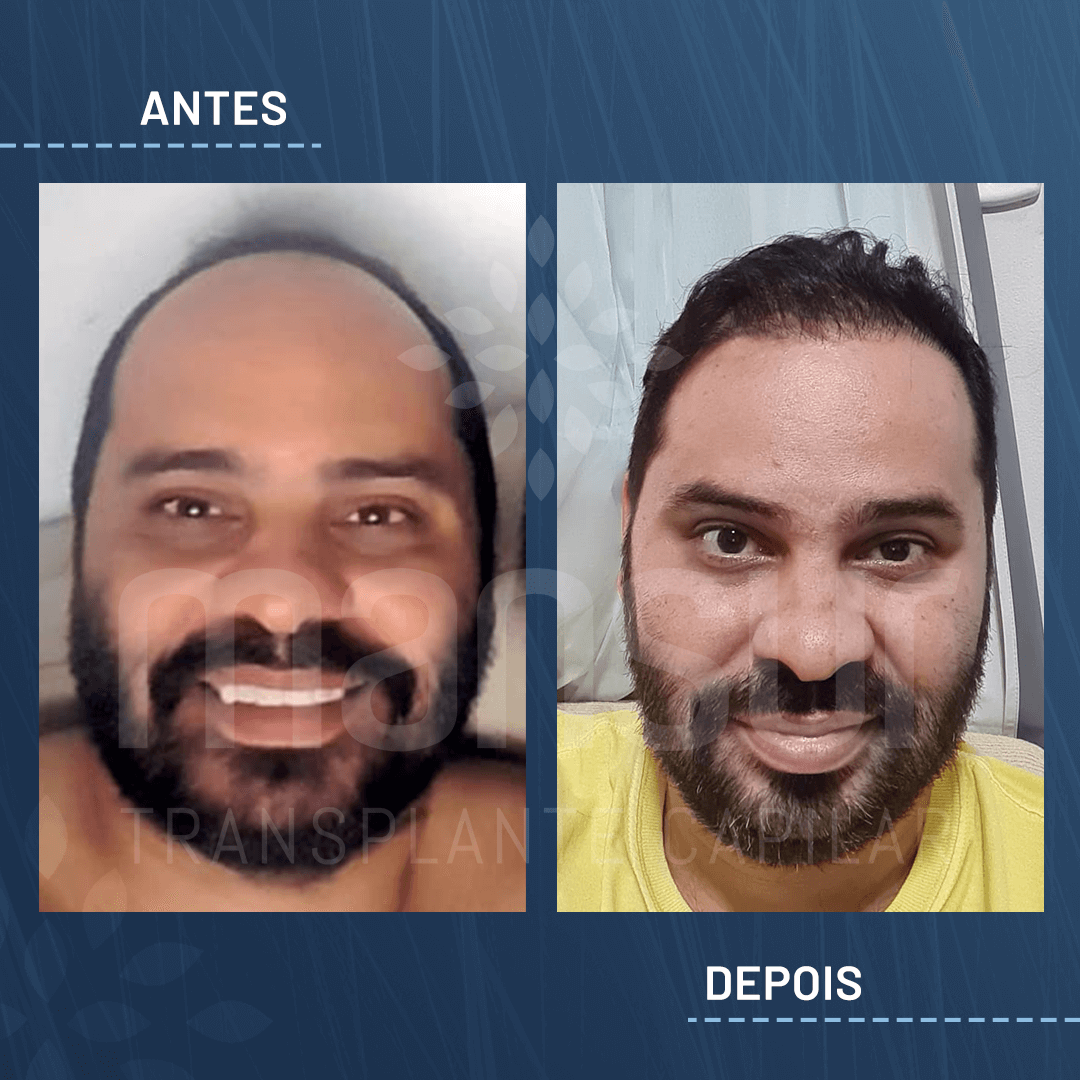 Antes e Depois_site_aprovado_Alessandro