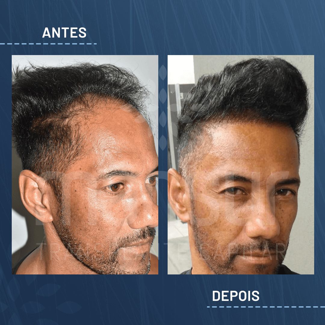 Antes e Depois_site_aprovado_Evaldo