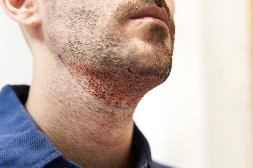 Transplantar Cabelo da Barba para a Cabeça