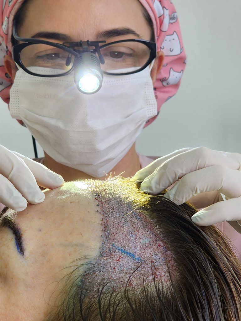 Transplante Capilar em Mulheres (2)