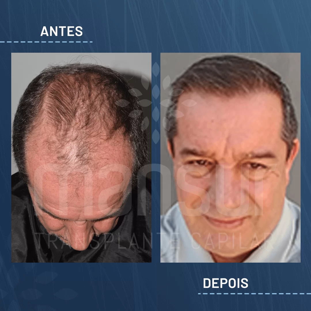 Antes e Depois_site_Luis Antonio Carpi