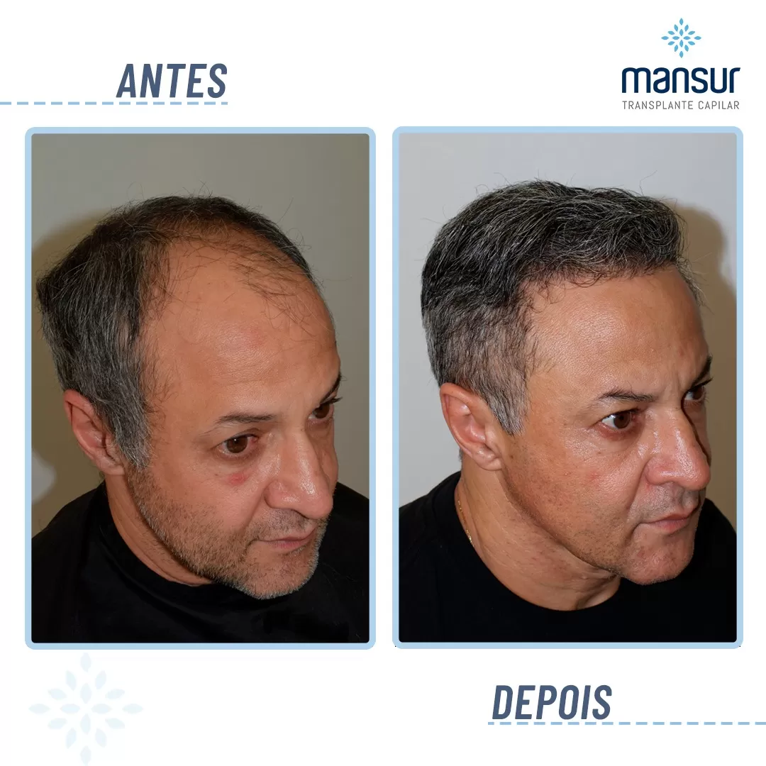 antes-depois1
