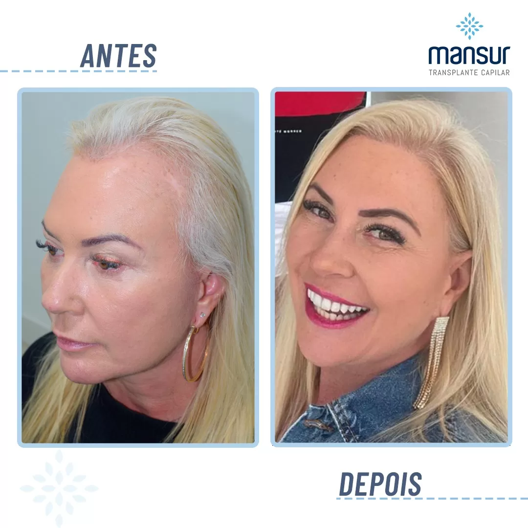antesdepois-3