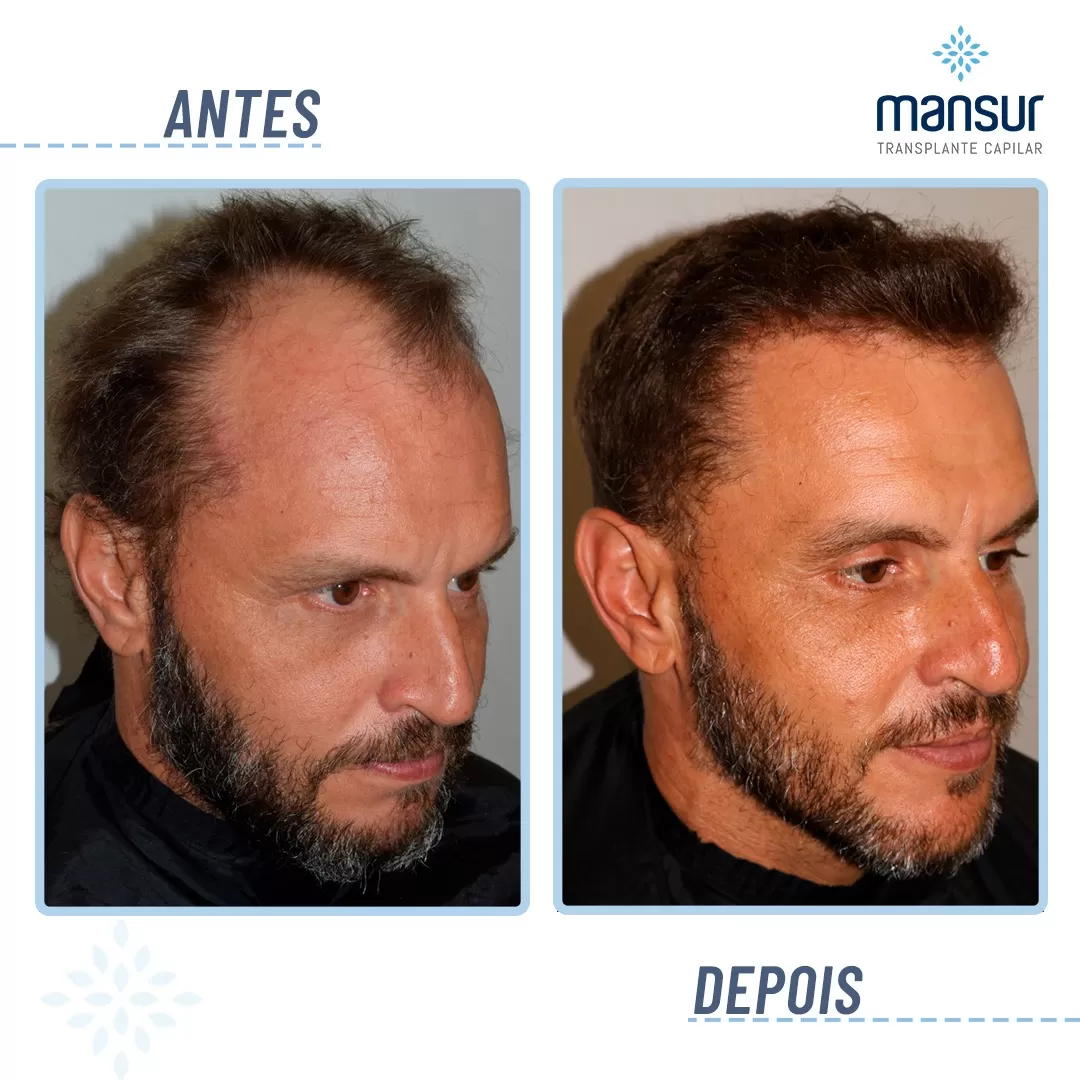 antesdepois-4