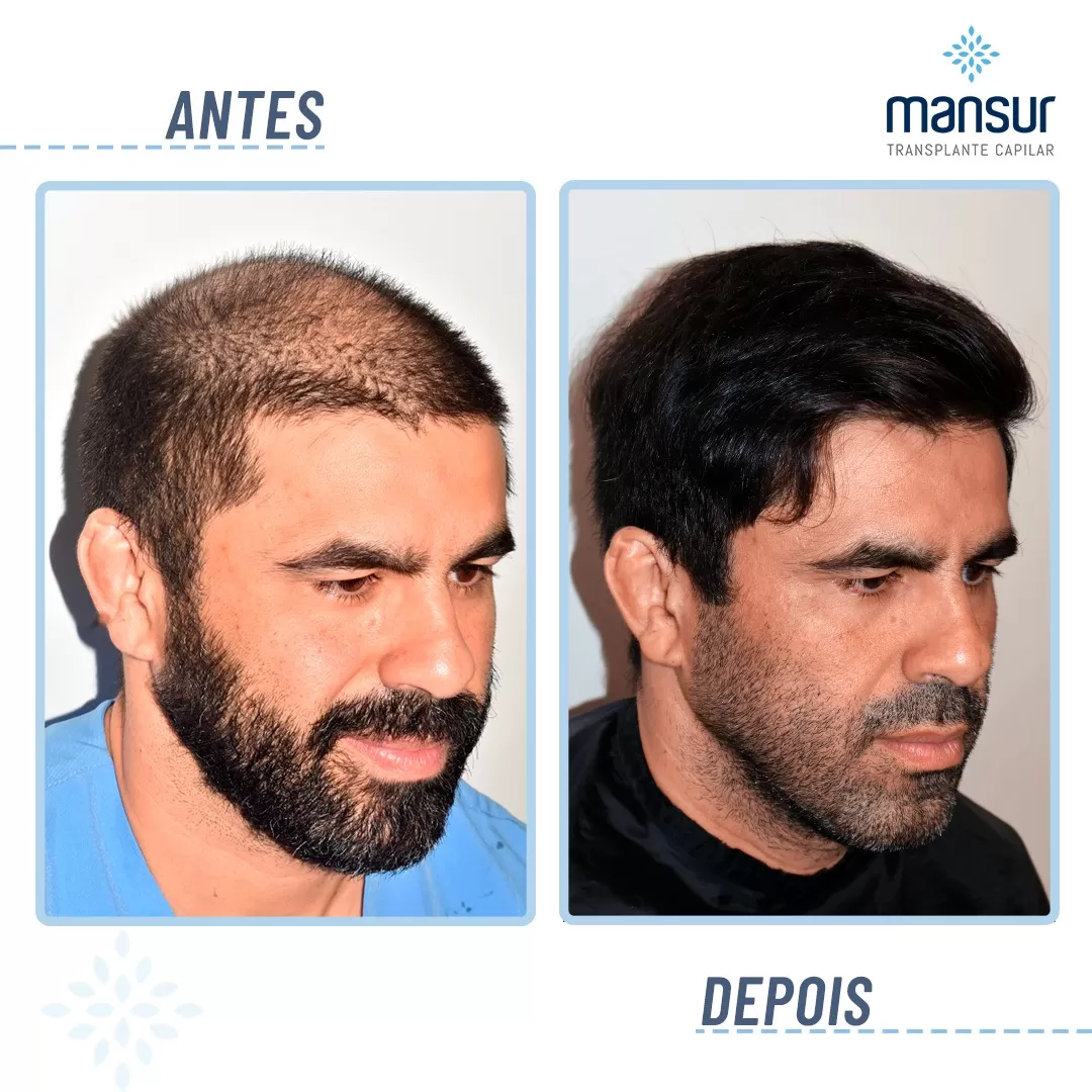 antesdepois-5