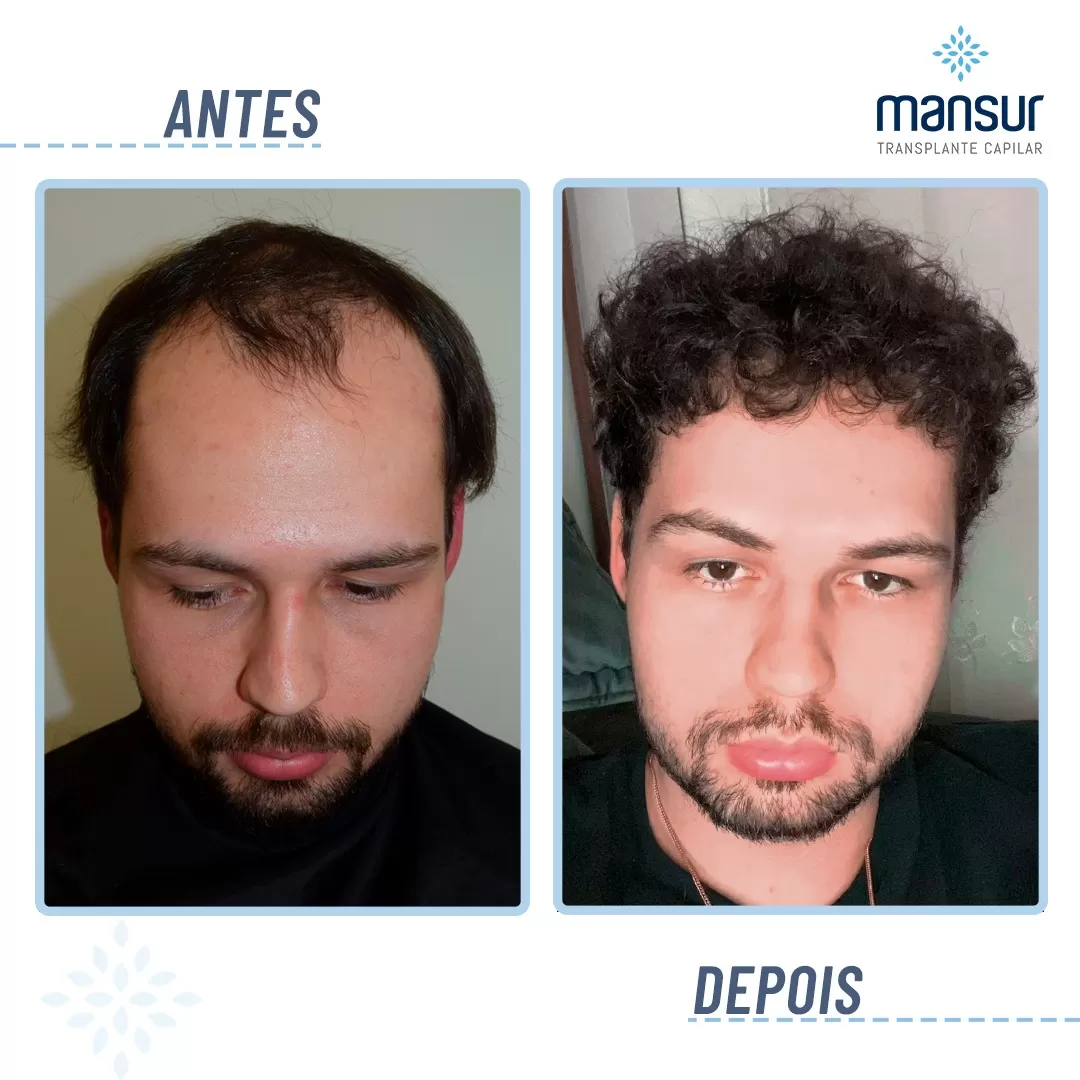 antesdepois-7