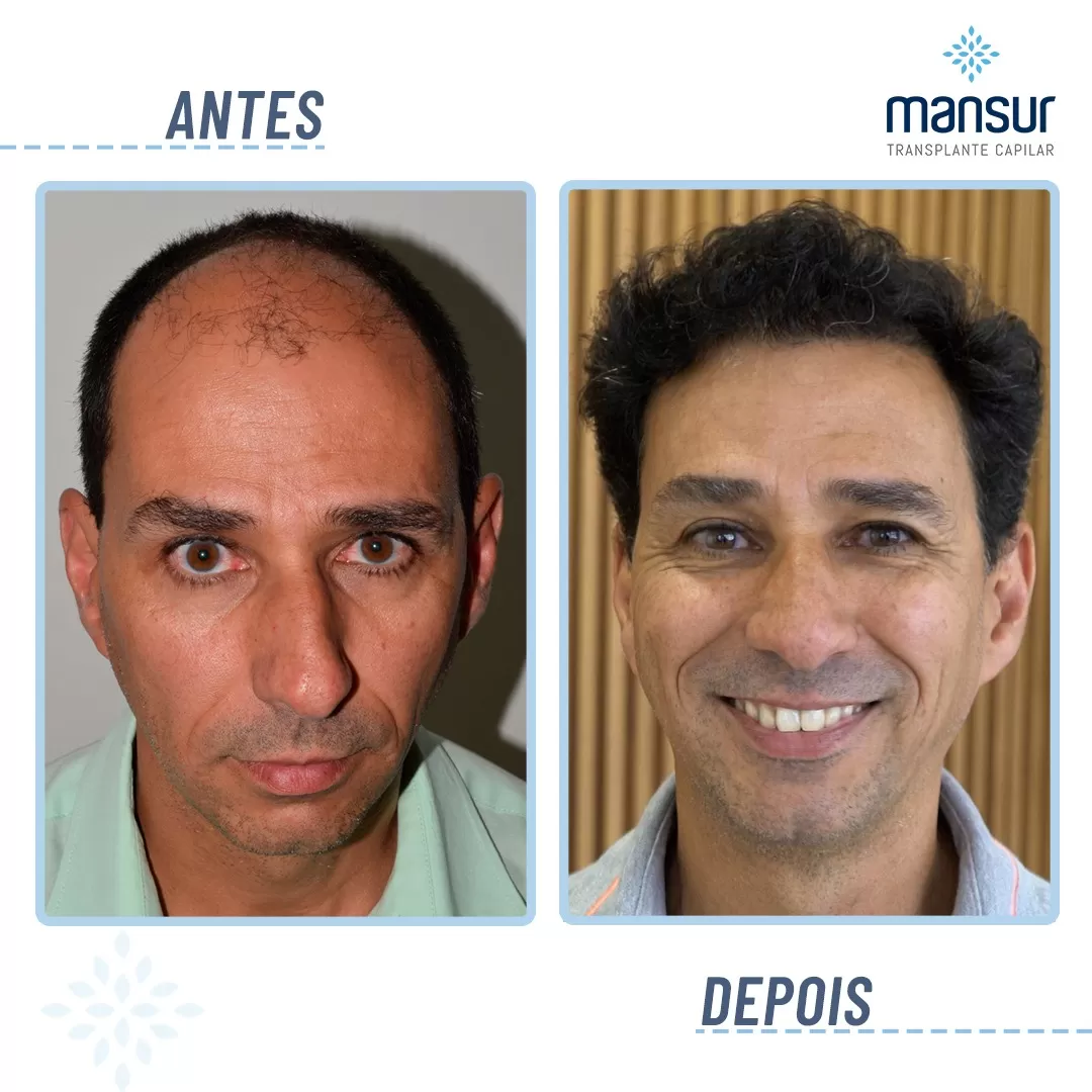 antesdepois-8