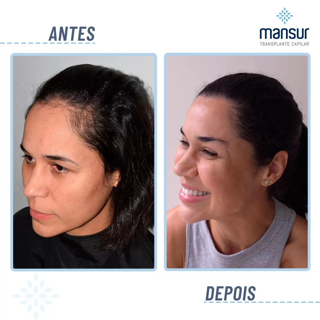 antesdepois10
