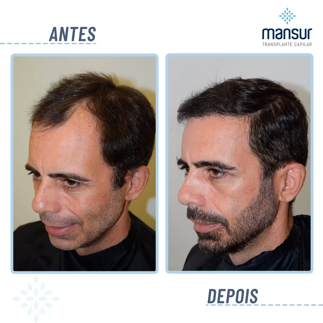 antesdepois9
