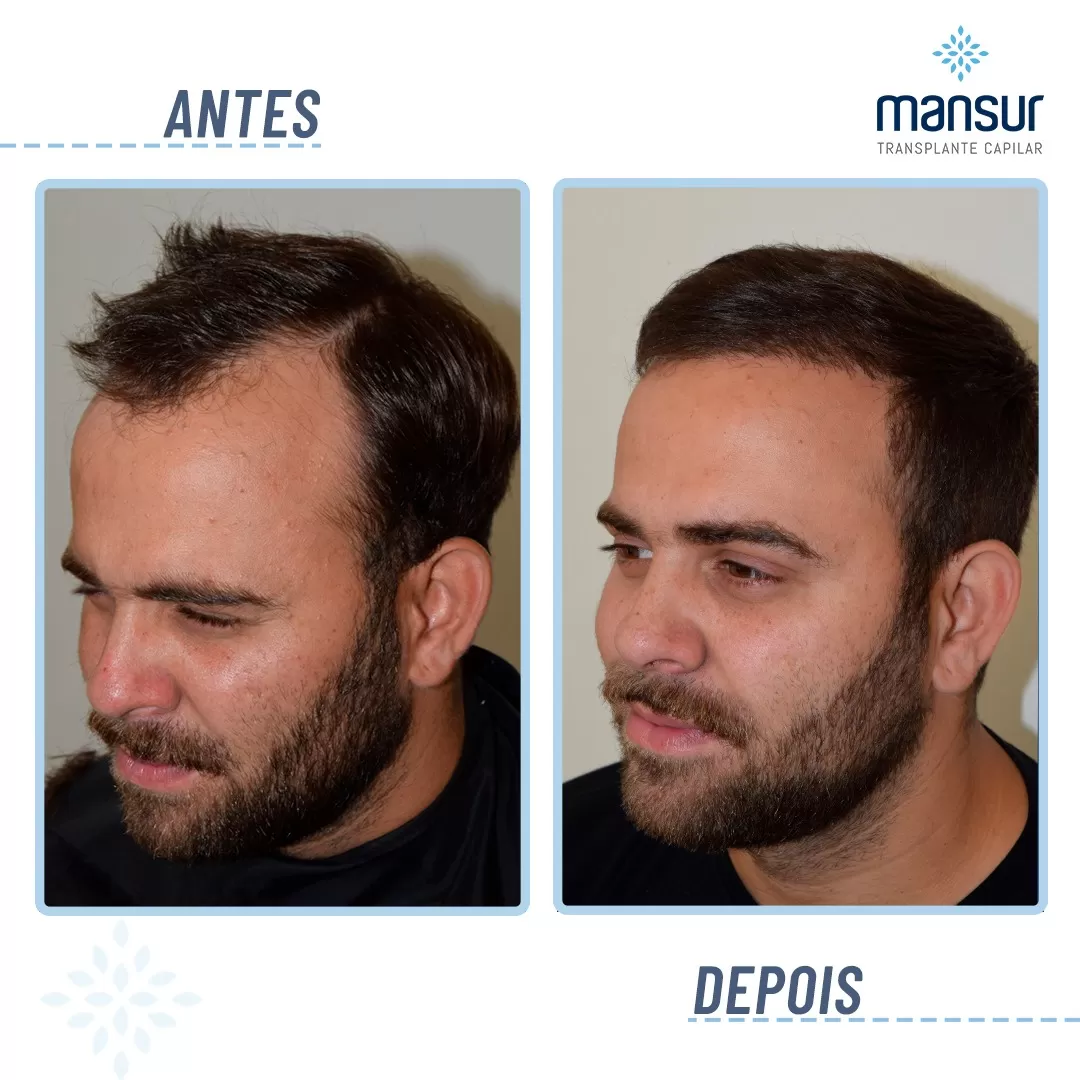 antesdepos-3